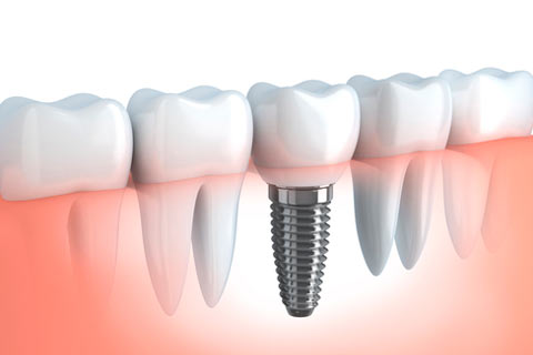 Restorative Implants